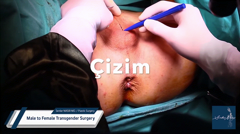 시청주의 ★ [극혐] 성전환 수술장면 7V 미리보기 1