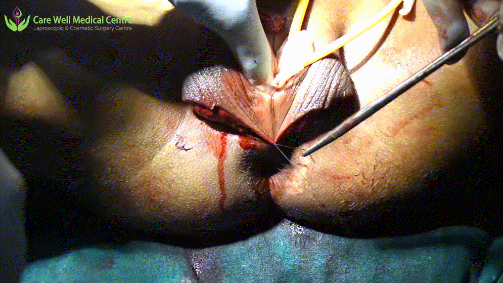 시청주의 ★ [극혐] 성전환 수술장면 7V 미리보기 2