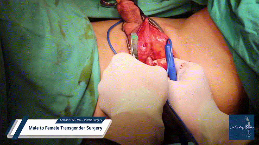 시청주의 ★ [극혐] 성전환 수술장면 7V 미리보기 4