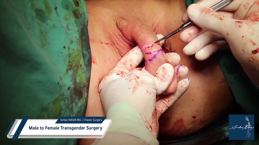 시청주의 ★ [극혐] 성전환 수술장면 7V 미리보기 5