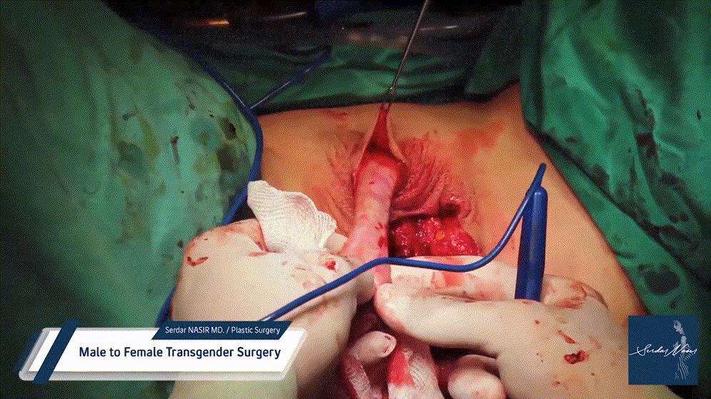 시청주의 ★ [극혐] 성전환 수술장면 7V 미리보기 6