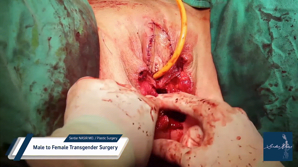 시청주의 ★ [극혐] 성전환 수술장면 7V 미리보기 7