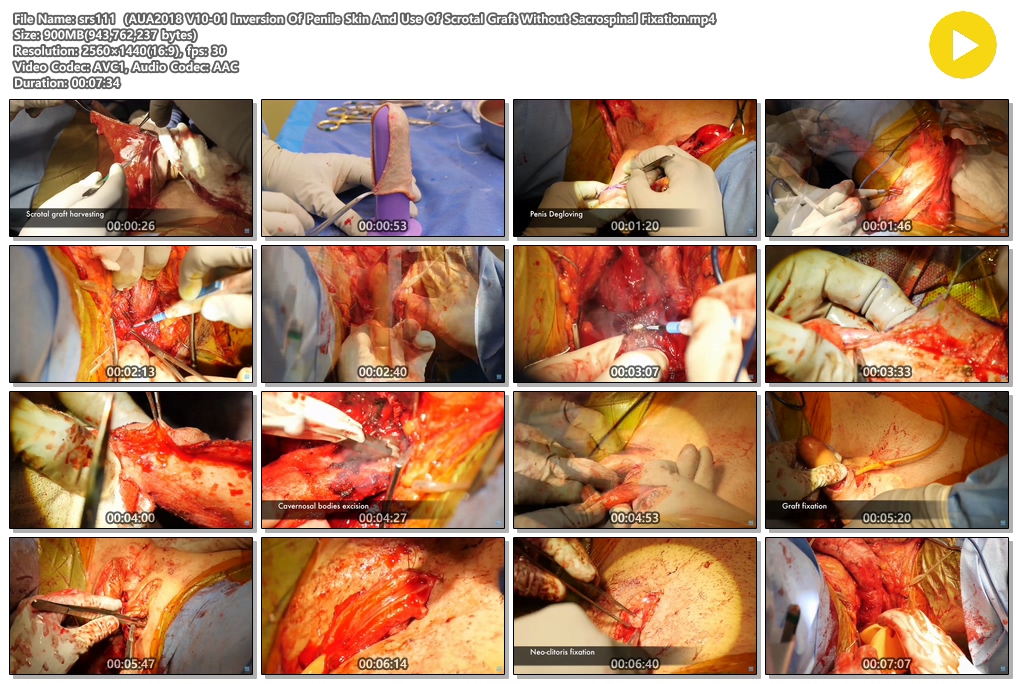 시청주의 ★ [극혐] 성전환 수술장면 7V 미리보기 13