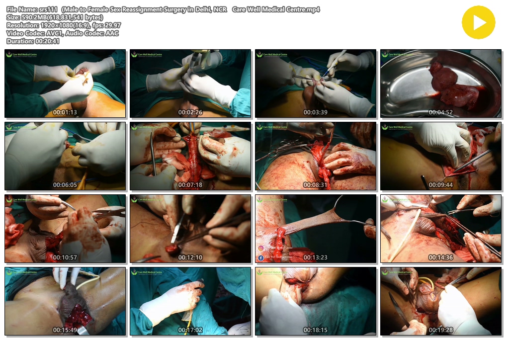 시청주의 ★ [극혐] 성전환 수술장면 7V 미리보기 14