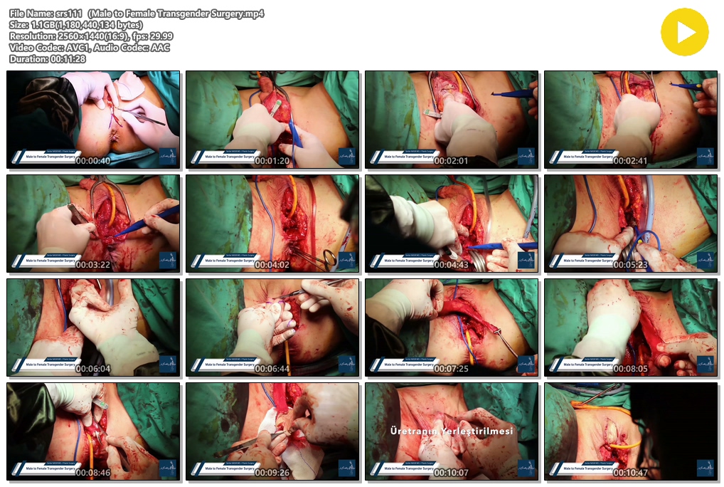 시청주의 ★ [극혐] 성전환 수술장면 7V 미리보기 15