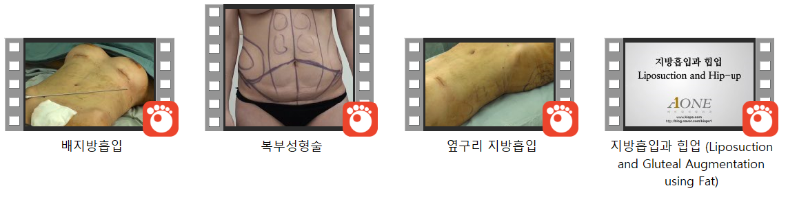 [혐⚠️주의] 지방흡입수술 4V _ 실제수술장면 미리보기 5