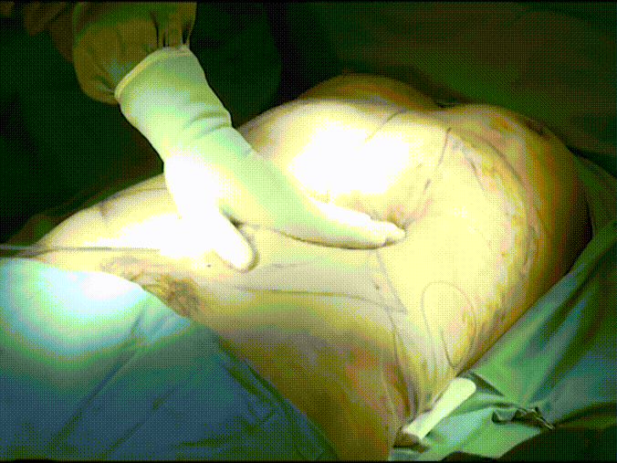 [혐⚠️주의] 지방흡입수술 4V _ 실제수술장면 미리보기 7