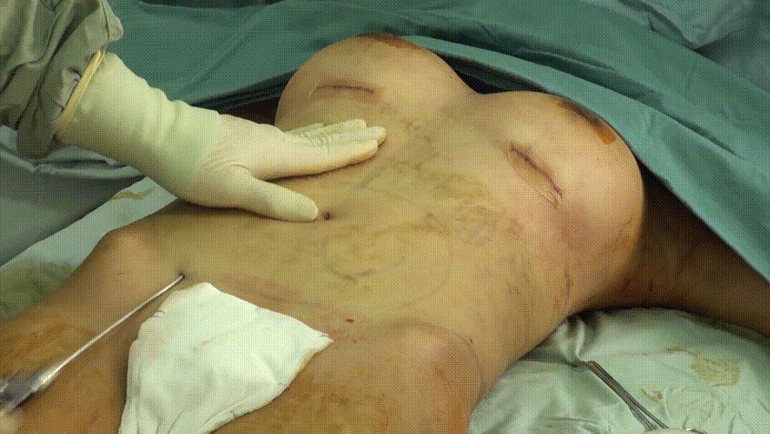 [혐⚠️주의] 지방흡입수술 4V _ 실제수술장면 미리보기 8